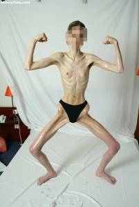 EXTREME-Skinny-Anorexic-Janine-1-07btsh3mth.jpg