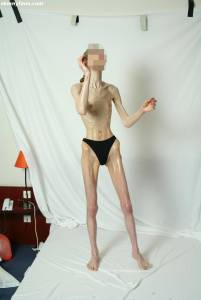 EXTREME-Skinny-Anorexic-Janine-1-i7btsi1z4k.jpg