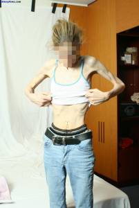 EXTREME-Skinny-Anorexic-Janine-1-z7btsba77p.jpg