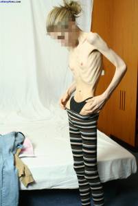 EXTREME-Skinny-Anorexic-Janine-1-d7btsb1ty4.jpg