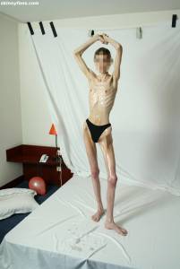 EXTREME-Skinny-Anorexic-Janine-1-u7btsh13qc.jpg