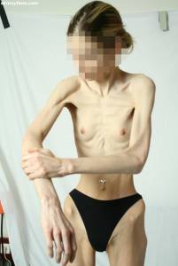 EXTREME-Skinny-Anorexic-Janine-1-p7btsgfeak.jpg